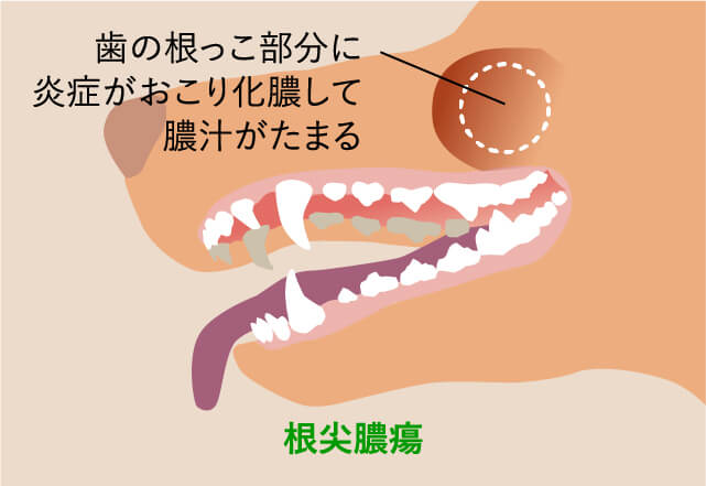 根尖膿瘍・口鼻瘻管・下顎骨骨折イラスト