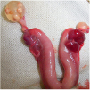 卵巣腫瘍イメージ