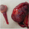 精巣（睾丸）腫瘍イメージ