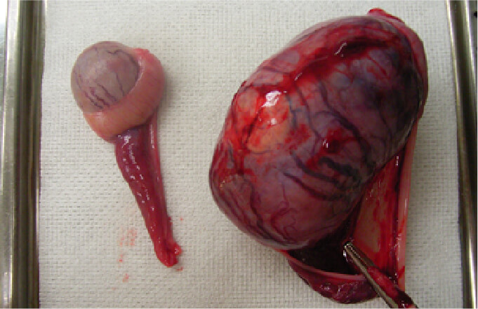 精巣（睾丸）腫瘍イメージ