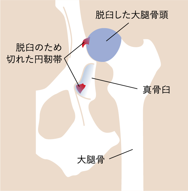 股関節脱臼（包帯法とトグルピン法）イラスト