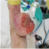 皮膚腫瘍手術前イメージ