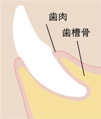 歯周病イラスト