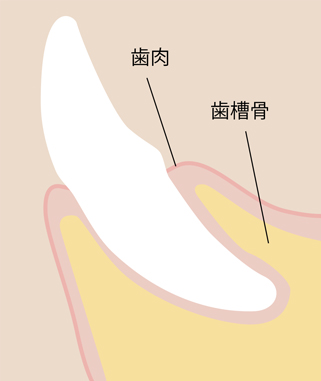 歯周病イラスト