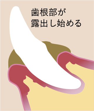 歯周病イラスト