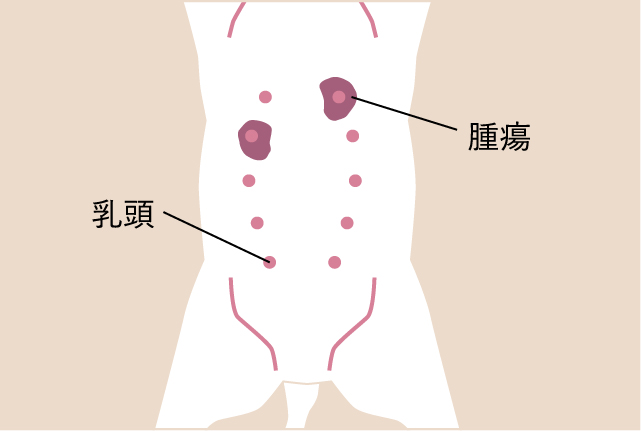 乳腺腫瘍イラスト