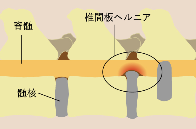 椎間板ヘルニアイラスト