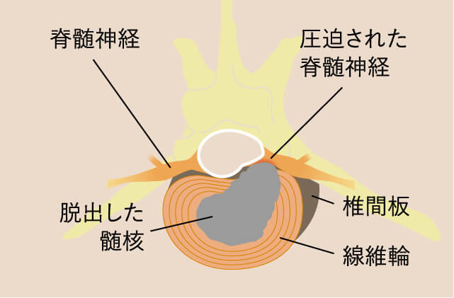 椎間板ヘルニアイラスト