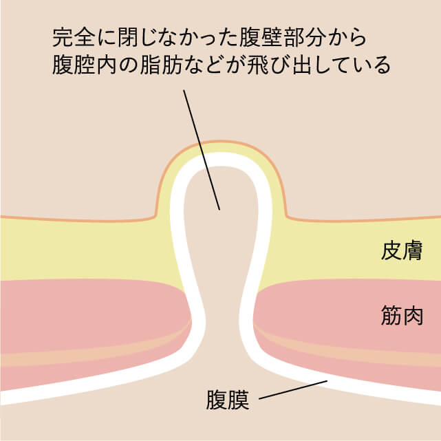 臍ヘルニアイラスト