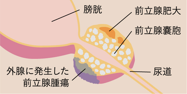 前立腺疾患イラスト