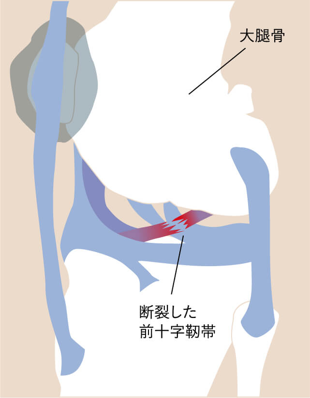 前十字靭帯断裂イラスト