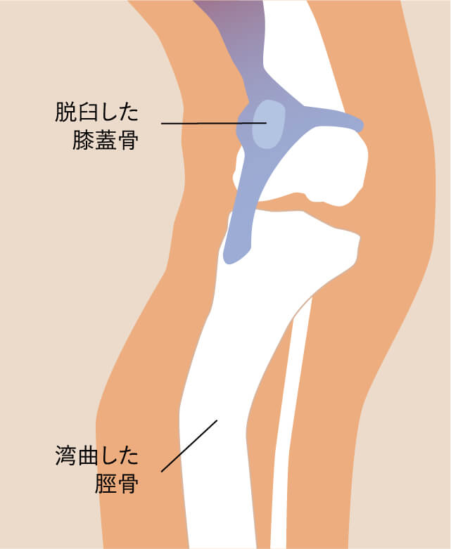 膝蓋骨脱臼症候群イラスト