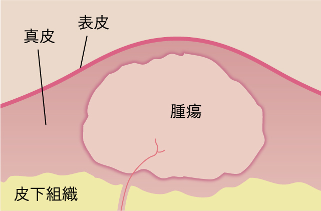 皮膚腫瘍イラスト